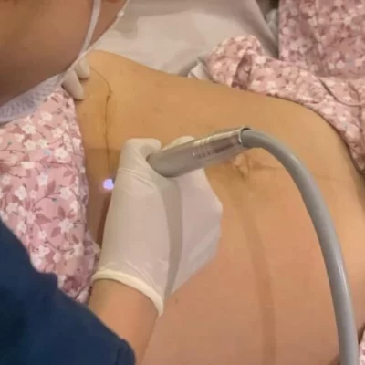 Chiếu tia plasma tại nhà điều trị vết mổ sau sinh