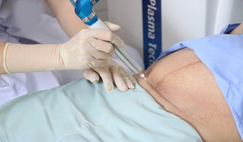 Chiếu tia plasma lạnh – Công nghệ tối ưu trong điều trị liền vết thương