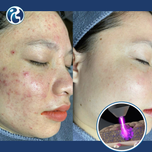 Chiếu tia Plasma điều trị nám, mụn, tái tạo da