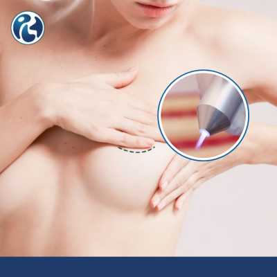 Chiếu tia plasma sau Phẫu thuật nâng ngực