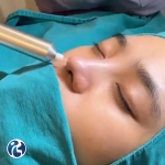 PlasmaMed – PlasmaRosy: Lựa chọn vàng Trong Điều Trị Thẩm Mỹ