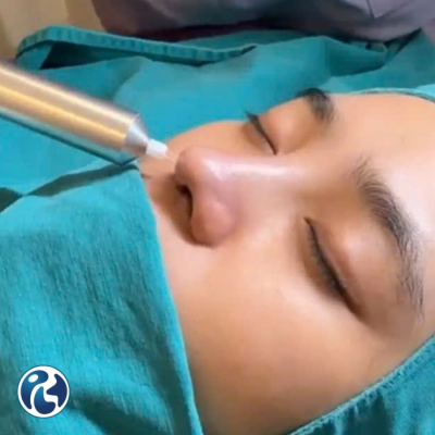 Chiếu tia Plasma phục hồi Vết mổ Phẫu thuật Thẩm mỹ