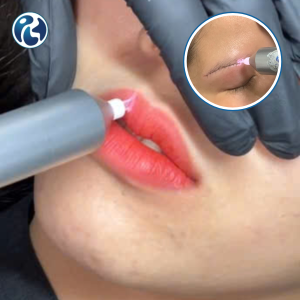 Chiếu tia plasma phục hồi đa tầng sau Phun xăm thẩm mỹ