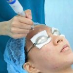 PlasmaRosy: Bước Tiến Trong Công Nghệ Điều Trị Sẹo Rỗ