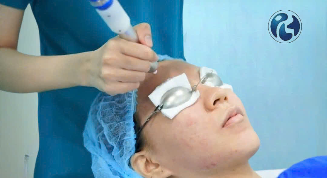 Sử dụng Plasma sẹo rỗ giúp giảm ngay các triệu chứng đau, sưng, nóng rát và đỏ sau Laser.