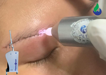 Plasma lạnh diệt vi khuẩn như thế nào theo Cơ chế khoa học ?