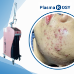 Plasma lạnh phục hồi da sau laser và phẫu thuật thẩm mỹ