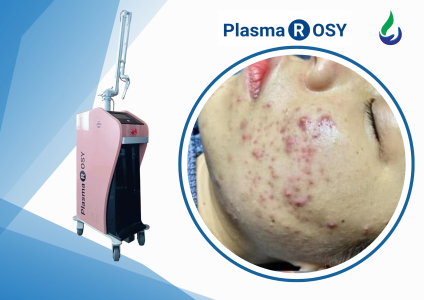Plasma lạnh phục hồi da sau laser và phẫu thuật thẩm mỹ