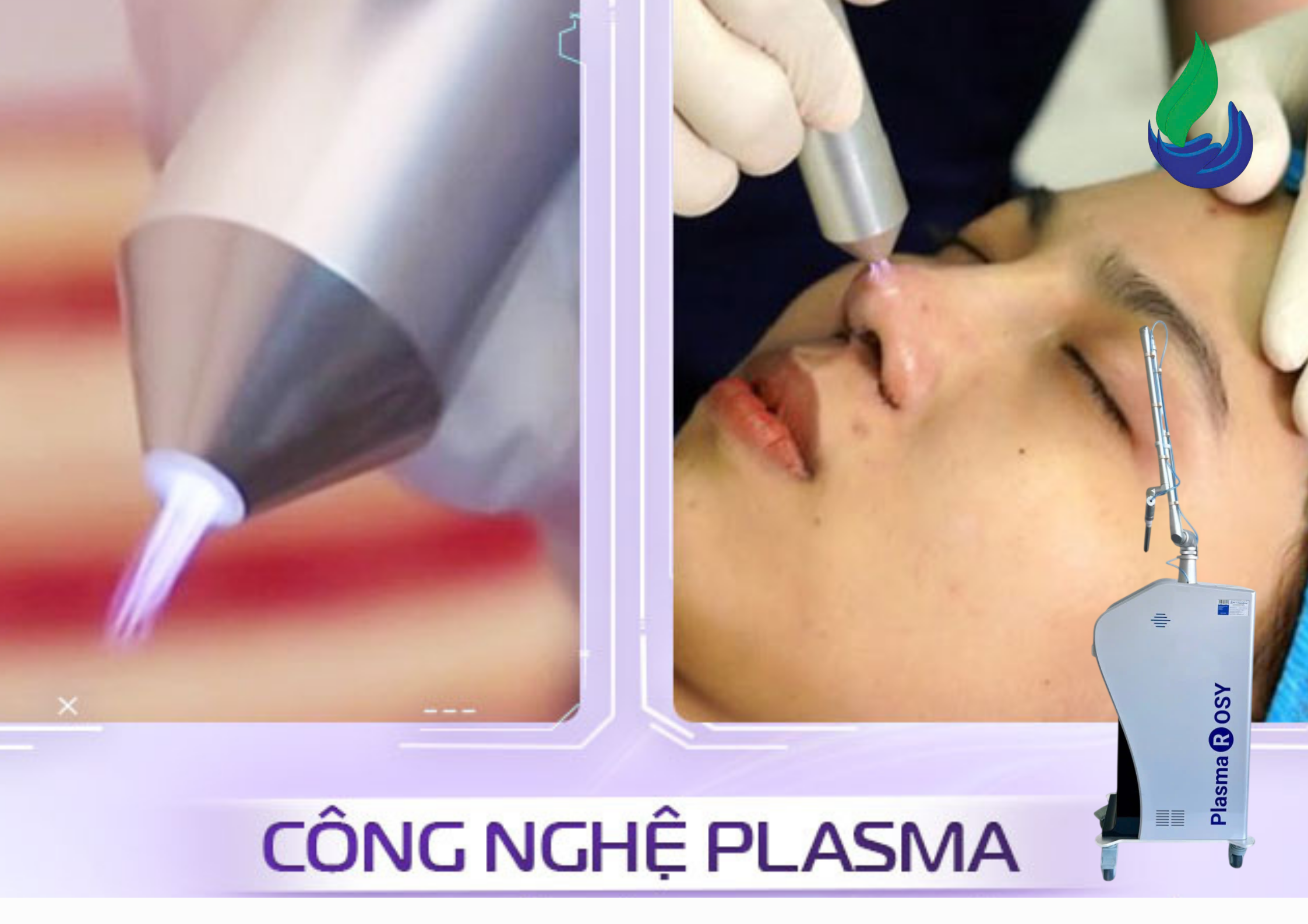 PlasmaRosy® can thiệp trực tiếp giúp:Quét sạch vi khuẩn bề mặt: Ngăn chặn viêm nhiễm ngay lập tức.