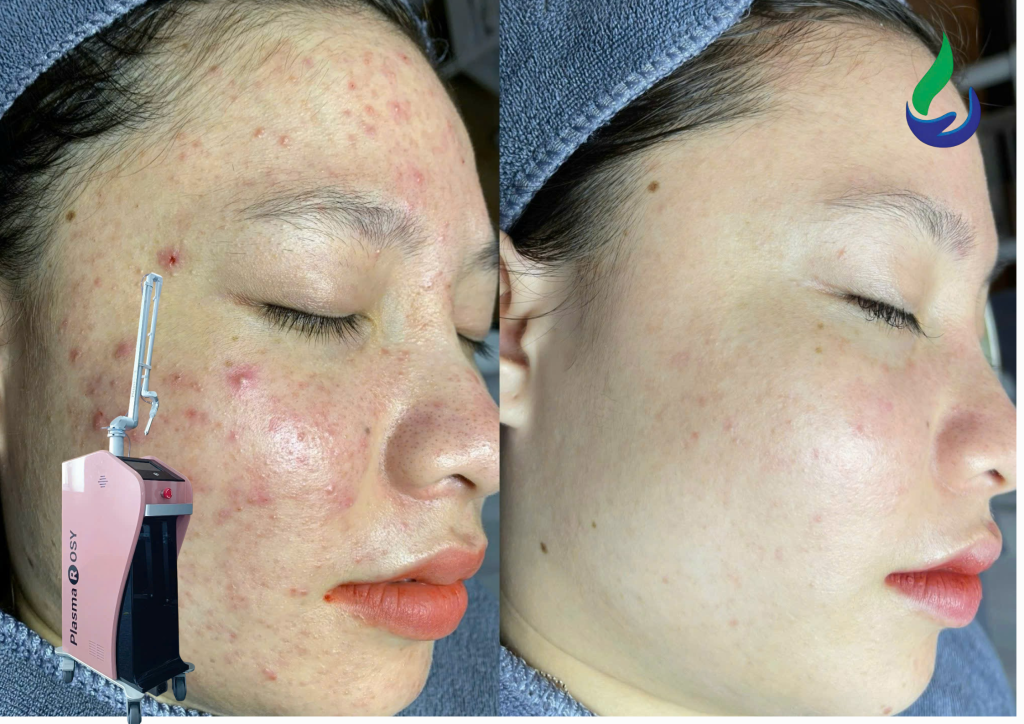 Plasma lạnh có an toàn cho da không?