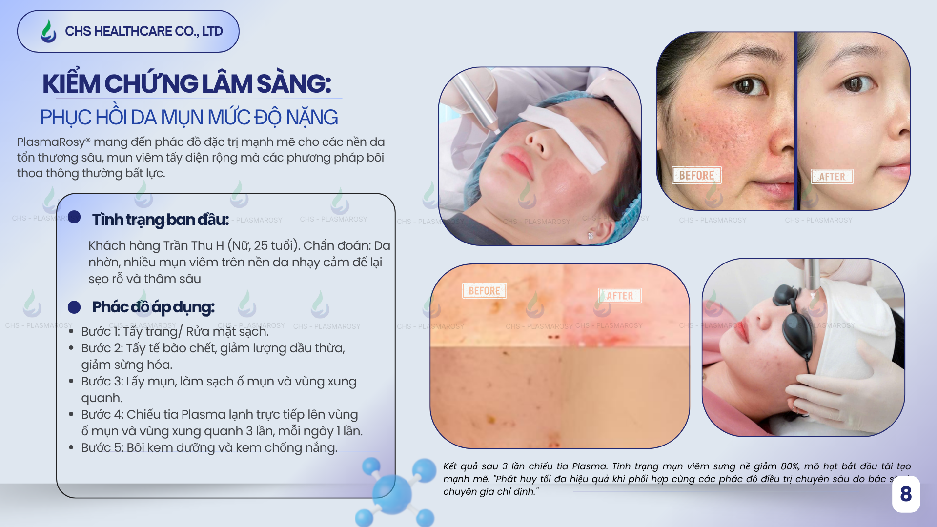 Da liễu chuyên sâu: điều trị mụn khi tiêu diệt vi khuẩn P.acnes, phục hồi da sau Laser, giảm nguy cơ tăng sắc tố (PIH).