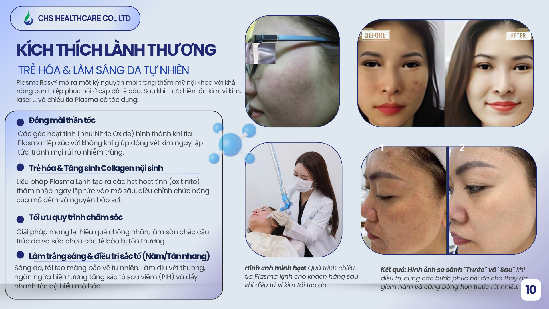 PlasmaRosy giúp Trẻ hóa da, tái tạo làn da: Điều trị thâm nám khi kết hợp với các liệu trình Laser, Meso, Vi kim